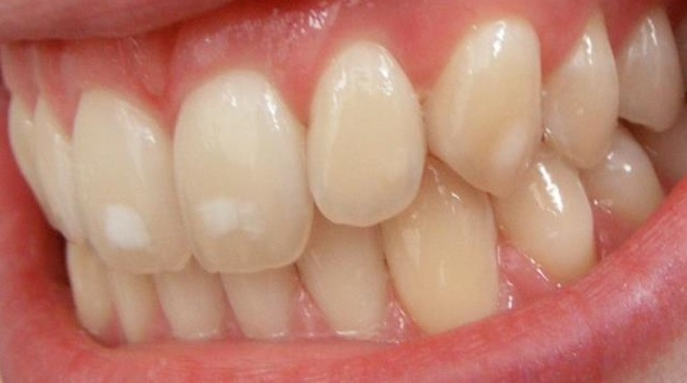 Mảng ố trên răng: Nhiễm flour ở răng là bệnh mạn tính phát triển ở cả 2 giai đoạn trước và sau khi mọc răng. Người mắc bệnh này thường có những mảng ố vàng trên răng, nếu không được điều trị dễ khiến mô răng bị phân hủy dẫn tới vỡ hoặc gãy răng.