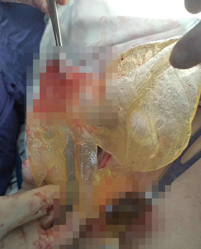Túi silicon bị vỡ được lấy ra khỏi ngực bệnh nhân
