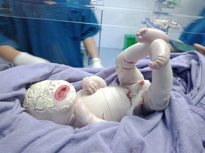 Trẻ sơ sinh ở Quảng Ninh mắc bệnh hiếm gặp toàn thân bao phủ da dày bị rạn thành từng mảng