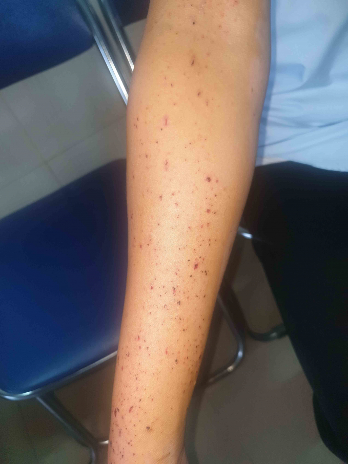 Tay một người bạn của Hiền bị bỏng
