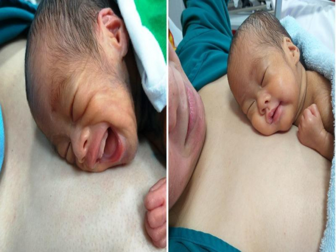Bé rất hay cười và bú sữa mẹ tốt (hình ảnh bé thời gian đầu mới sinh - trái và 57 ngày sau sinh). Ảnh: BVCC