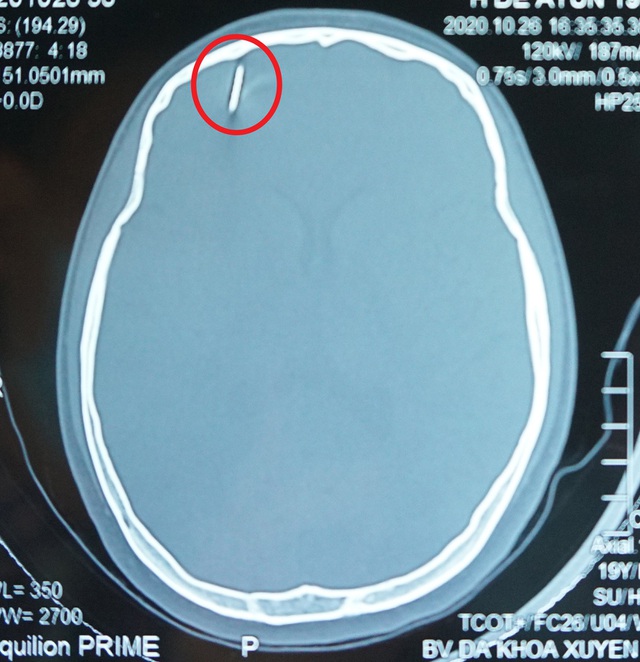 Chiếc đinh xuyên thấu hộp sọ bệnh nhân gây tổn thương nhu mô não