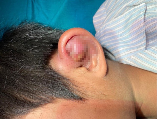 Bệnh nhân 9 tuổi bị viêm sụn vành tai nhưng không có điều kiện điều trị kịp thời vì mưa lũ nên dẫn tới áp-xe. Ảnh: BVCC.