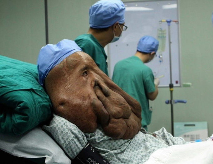 Chuncai chuẩn bị được phẫu thuật cắt bỏ khối u trên mặt lần thứ 4 vào ngày 25/12/2013. Ảnh: Yu Zongheng/CFP.