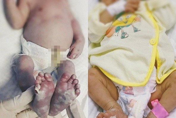 Bé sơ sinh mắc giang mai khỏi bệnh sau 20 ngày điều trị tại Bệnh viện Sản Nhi Nghệ An. Ảnh: BVCC.