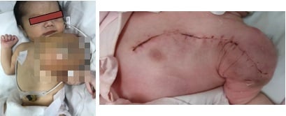 Hình ảnh bệnh nhân trước và sau mổ
