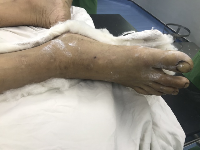Chân của bệnh nhân tím tái trước khi được phẫu thuật