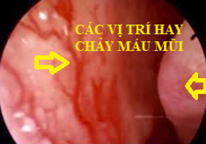 chay_mau_mui