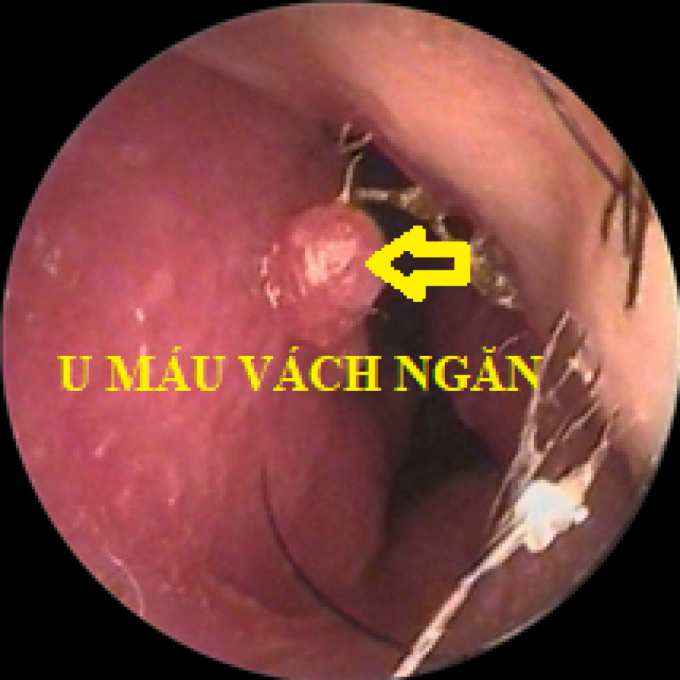chay_mau_mui_2