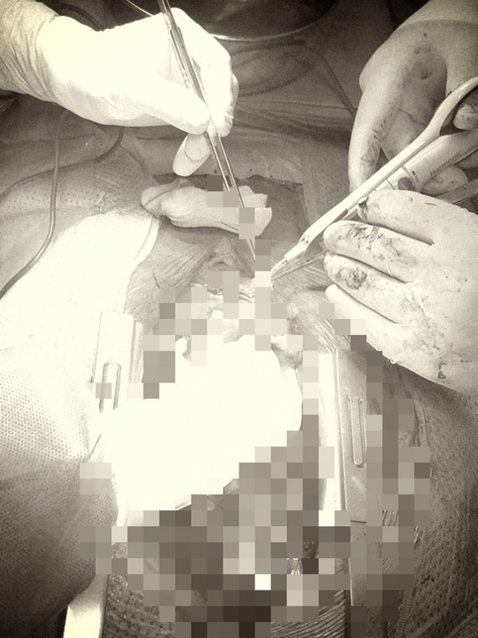 Ê-kíp phẫu thuật lấy động mạch vị mạc nối phải bằng dao siêu âm