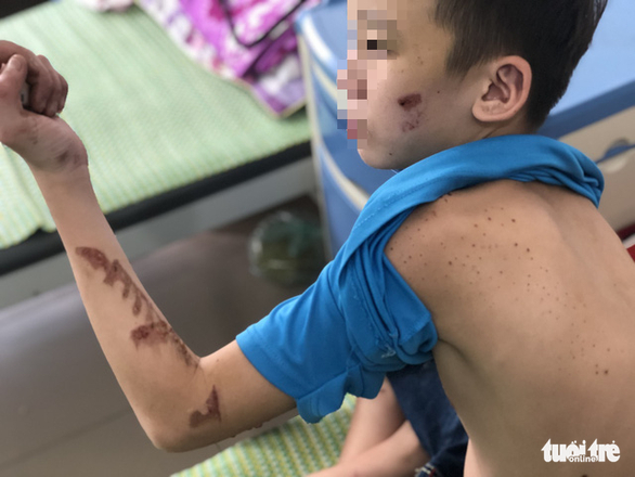 Nạn nhân N.Q.D. bị đánh thương tích đầy người, đang điều trị tại Trung tâm Y tế huyện Yên Phong - Ảnh: DANH TRỌNG