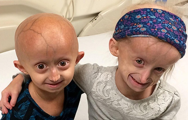 Trẻ mắc Progeria thường không sống quá 15 tuổi. Ảnh: Quỹ Progeria Research.