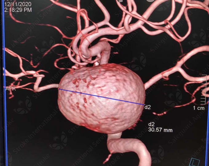 Túi phình mạch máu não với đường kính 3 cm được ví như quả bom của bệnh nhân. Ảnh: BVCC.