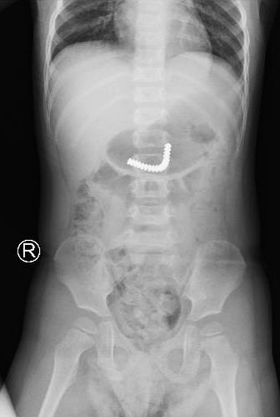 Qua chụp X-quang, bác sĩ phát hiện dị vật trong dạ dày bé trai
