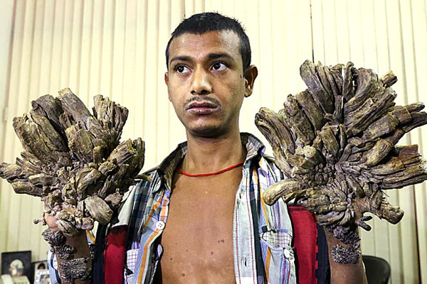 Anh Abul Bajandar (Bangladesh) trải qua hơn 20 ca phẫu thuật do bị bệnh người cây. Ảnh: Gulf News