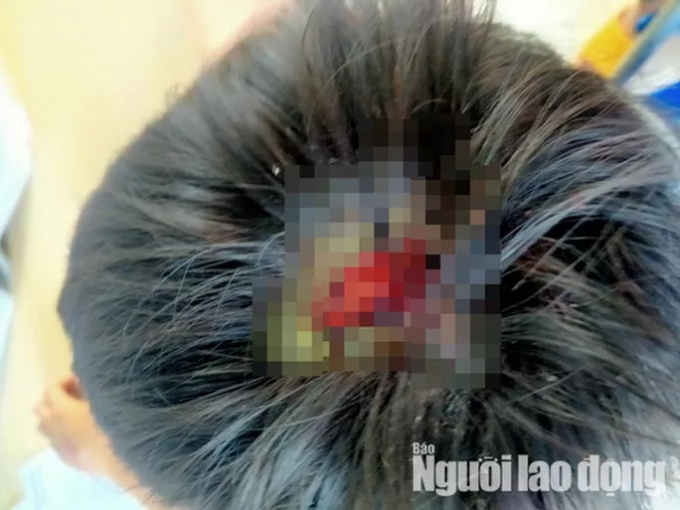 Một mảng da đầu cháu Boy bị rách