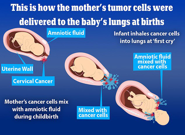 Ảnh đồ họa của nhóm tác giả mô tả con đường lây truyền từ mẹ sang con trong bệnh ung thư cổ tử cung. Các tế bào ung thư (màu đỏ) nằm trong chất lỏng ở ống sinh (màu xanh) có thể tiếp xúc với đứa bé khi bé đang thoát khỏi bụng mẹ, đi vào đường thở khi bé hít chất lỏng đó