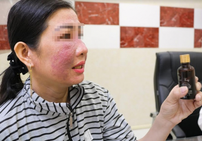 Mặt bà H. sưng nề do sử dụng mỹ phẩm không nguồn gốc quảng cáo trên mạng. Ảnh: BVCC