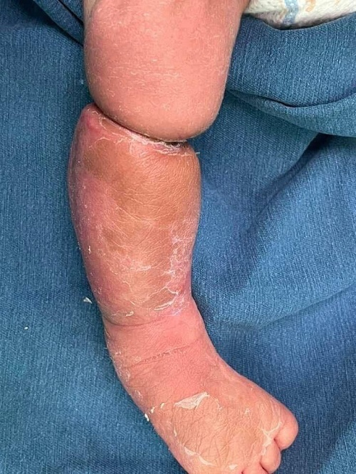 Hình ảnh vòng thắt ở cẳng chân phải bệnh nhi thời điểm nhập viện - Ảnh: BVCC