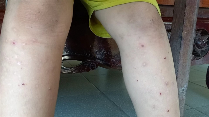 Trẻ em sinh sống nương tựa ở chùa Phước Minh cũng mắc bệnh ngoài da không rõ nguyên nhân. Ảnh: Hà Anh Chiến