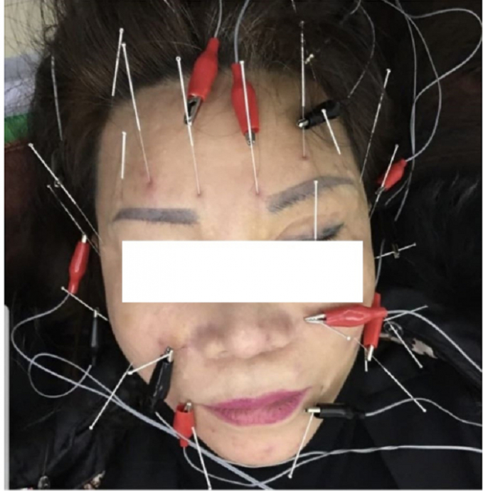 Sau phẫu thuật tại BVTM Kangnam, bà L phải châm cứu trị liệu khuôn mặt nhưng vẫn không khỏi hẳn