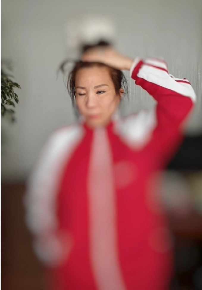 Sau phẫu thuật tại Kangnam, bà L bị lõm một bên má, một mắt không thể nhắm kín