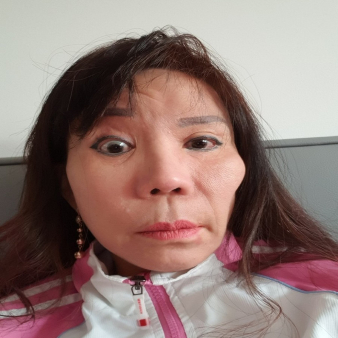 Khuôn mặt bà L.Đ. bị biến dạng và liệt dây thần kinh số 7 sau khi phẫu thuật căng da mặt tại Bệnh viện Thẩm mỹ Kangnam