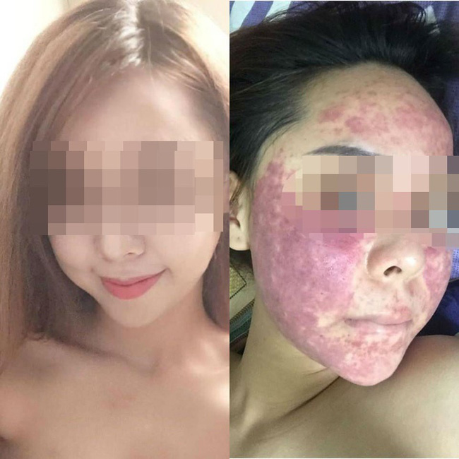 Hậu quả của sử dụng kem tự chế