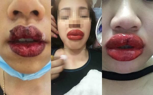 Xăm môi ẩn chứa rất nhiều nguy hiểm, đặc biệt ảnh hưởng tới thẩm mỹ của người sử dụng
