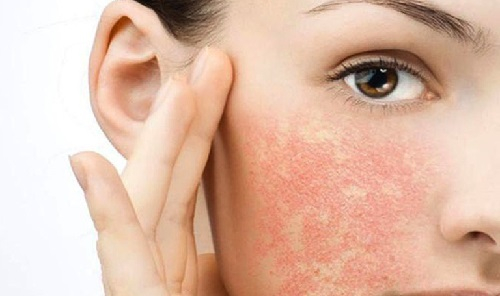 Kích ứng da do lựa chọn mỹ phẩm không phù hợp