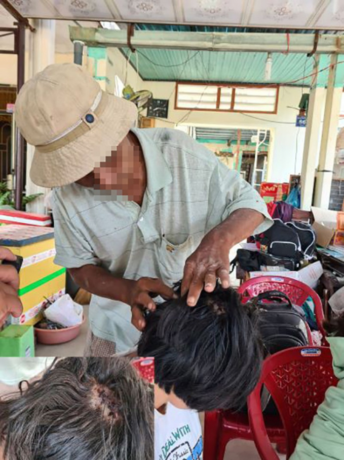 Em V. phải khâu 10 mũi trên đầu sau khi bị nam thanh niên đánh dã man. Ảnh: LÊ ÁNH