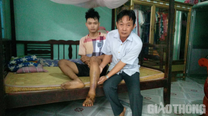 Ông Háo bên con trai là em Đinh Đại Phú bị thương tích nặng ở chân sau khi xảy ra vụ tai nạn.