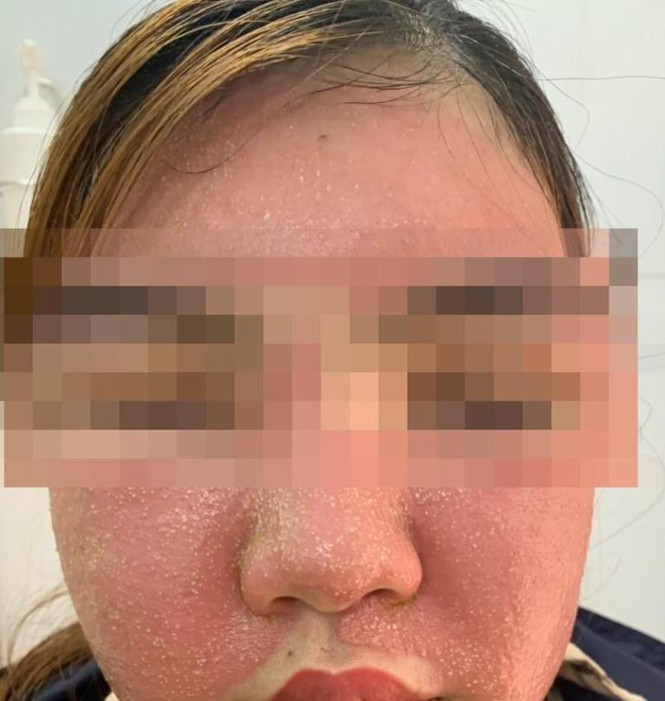 Ham trắng da, mặt nữ bệnh nhân sưng phù, mụn khắp mặt do dùng mặt nạ đông y mua trên mạng (ảnh: BVCC)
