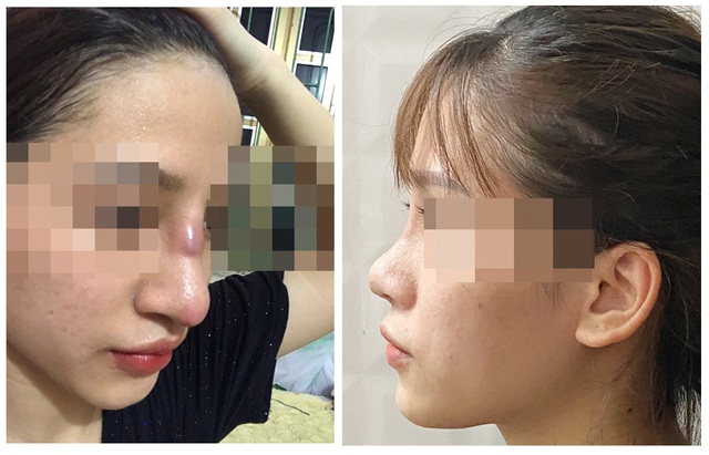 Hình ảnh mũi người bệnh trước (bên trái) và sau (bên phải) sau khi điều trị