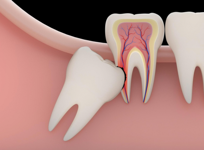 Răng khôn mọc lệch có thể ảnh hưởng nhiều răng khác. Ảnh: Medicaldental.