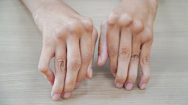 Bàn tay bị cong vẹo, biến dạng của người bị viêm đa khớp dạng thấp