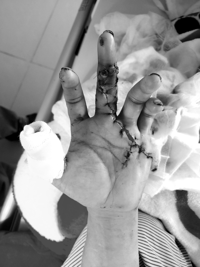 Bàn tay của bệnh nhân sau phẫu thuật