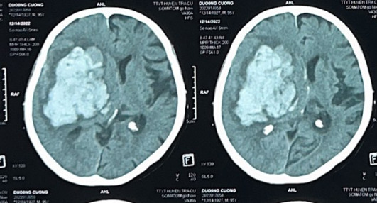 CT scan trước phẫu thuật của bệnh nhân Dương C