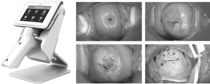 CerviCare AI là một hệ thống giải pháp có tên là TeleCervicography, hệ thống này bao gồm thiết bị thông minh Dr. Cervicam C20, TeleCervico (phiên bản kết nối mạng) và mạng lưới các chuyên gia đánh giá chuyên ngành