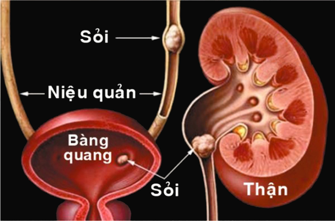 Sỏi tiết niệu là một bệnh thường gặp, dễ gây biến chứng 