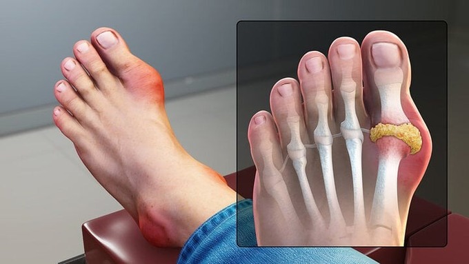 Bệnh gout có xu hướng trẻ hóa (ảnh minh họa: Sở Y tế TP. HCM)