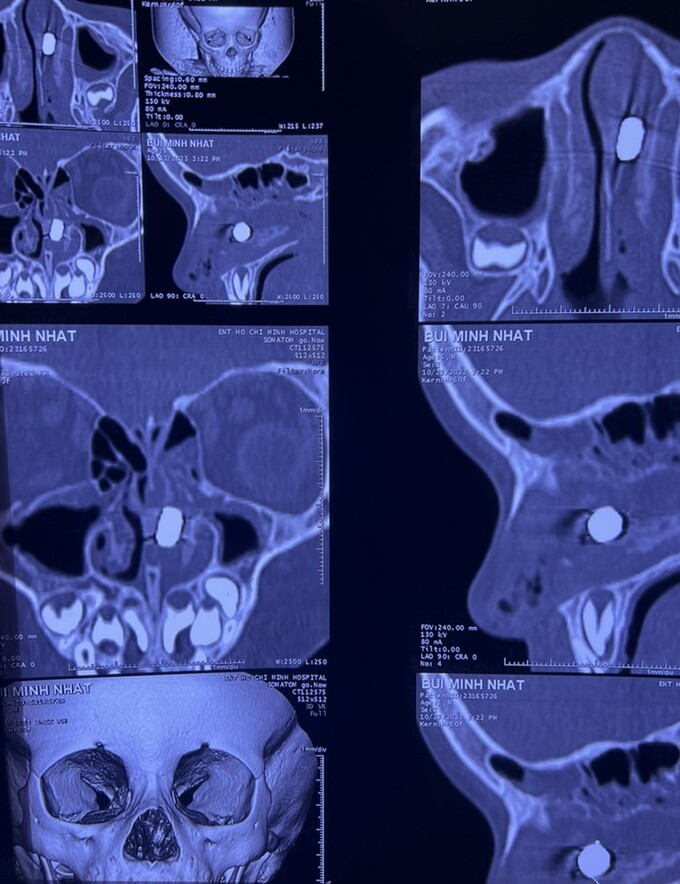 Ảnh chụp CT Scan mũi của bệnh nhi