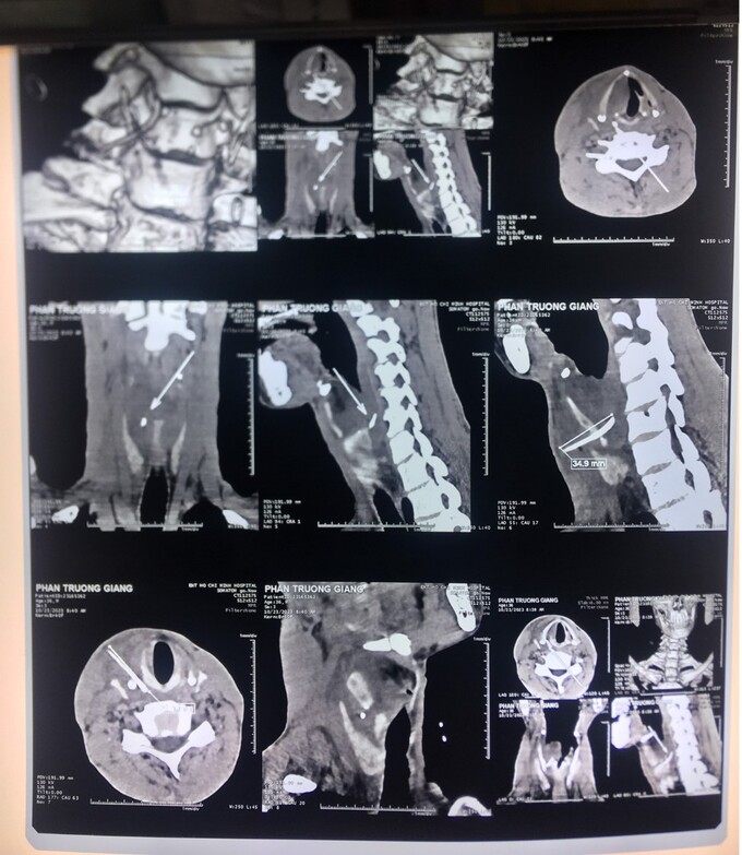 Kết quả chụp CT Scan của nam bệnh nhân bị hóc xương cá