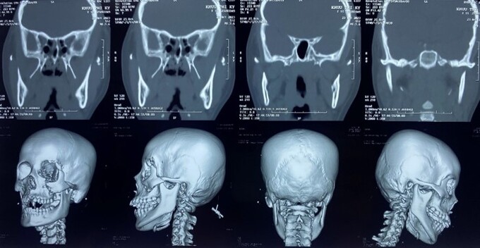 Hình ảnh chụp CT scan của bệnh nhân
