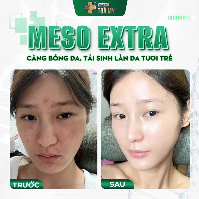 Hình ảnh khách hàng trước và sau khi thực hiện Meso Extra