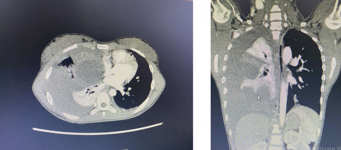 CT scan ngực ghi nhận xuất huyết phổi thùy giữa phải. có cấu trúc dạng nang chứa máu trong nhu mô sát rốn phổi. – tràn máu màng phổi lượng nhiều