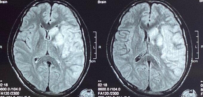 Kết quả chụp MRI của bệnh nhân P.T.A  (Ảnh BVCC)