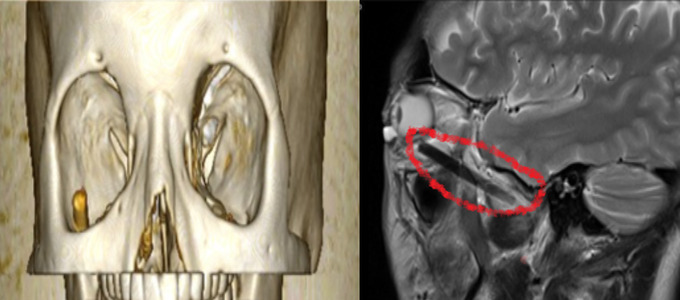 Hình ảnh chụp MRI và CT scan phát hiện một phần chiếc đũa nằm sâu trong hốc mắt