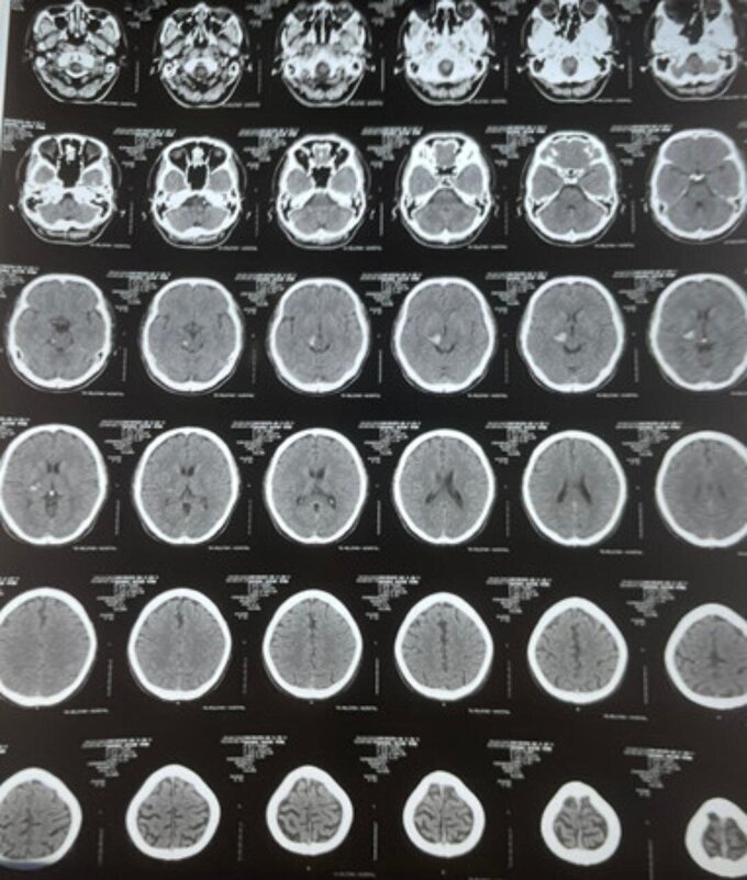 Phim chụp CT của bệnh nhân Nguyễn Văn Anh, 35 tuổi, ngụ quận 8, TP.HCM