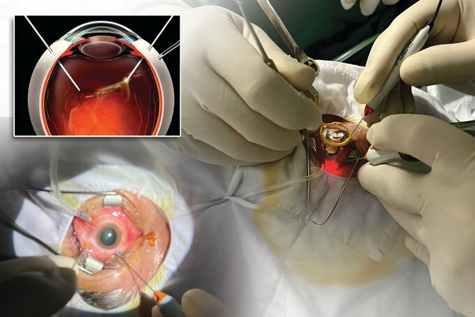 Phương pháp phẫu thuật cắt dịch kính